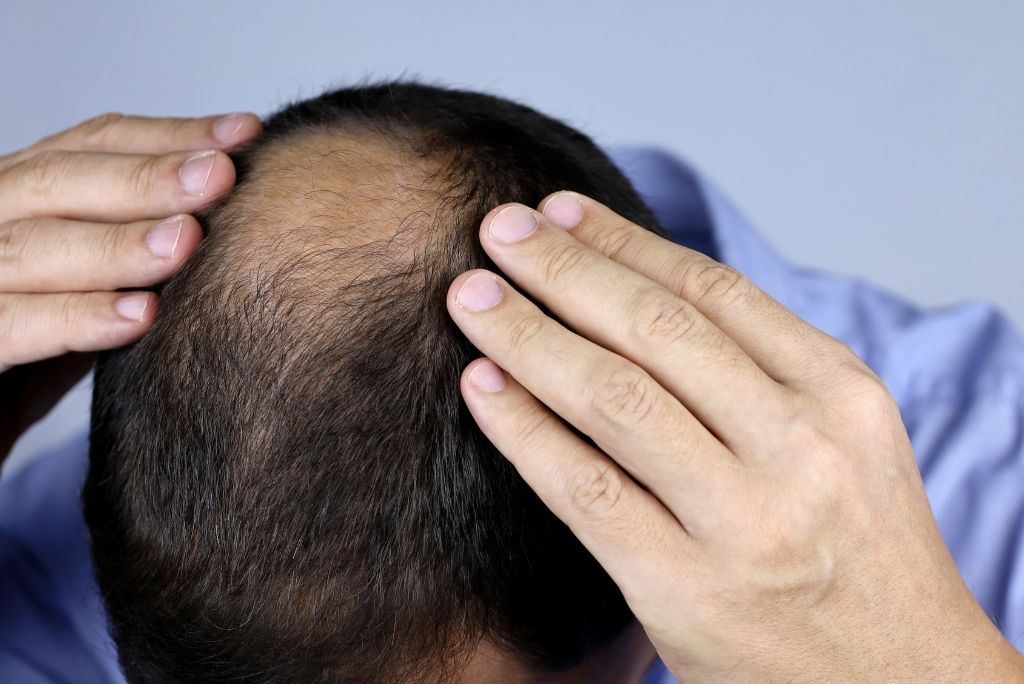Haarausfall und Kopfhautprobleme_ Ursachen und Auswirkungen