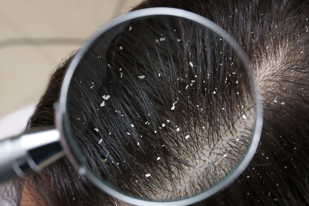 Was sind Schuppen und was hilft gegen Schuppen